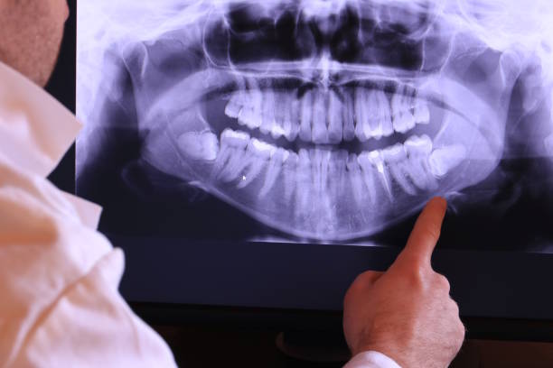 Best Emergency Dental Extractions in Lake Clarke Shores, FL